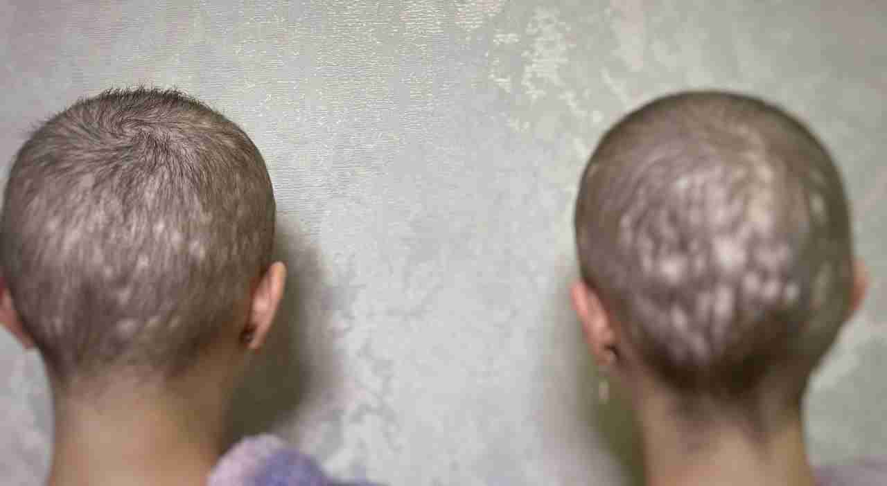 У Львові врятували 13-річних сестричок з повним випадінням волосся та відшаруванням шкіри (ФОТО)
