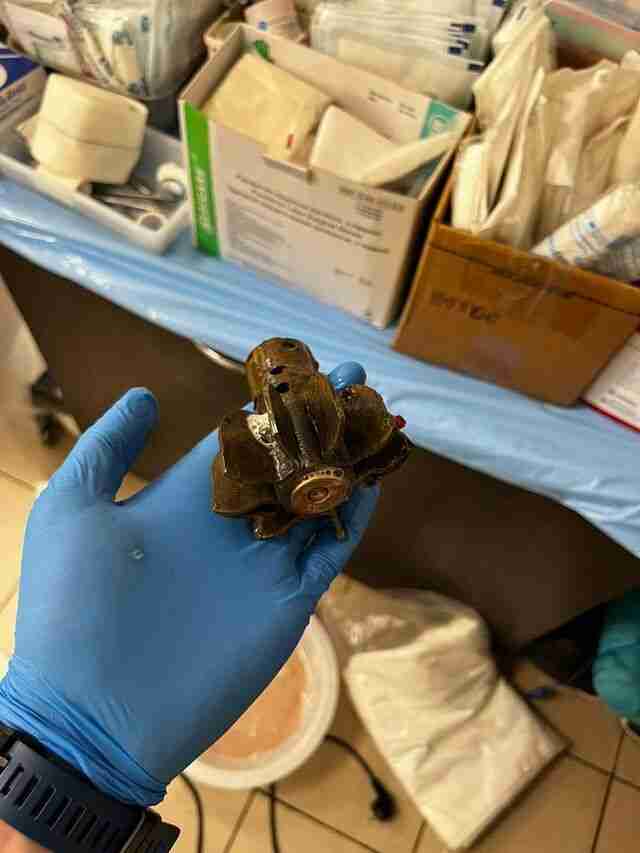 Допомагала бригада саперів: лікарі дістали хвостовик міни з тіла військовослужбовця (ФОТО)