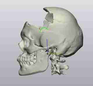 Куля влучила в голову і пройшла крізь мозок: у Львові зробили реконструкцію черепа захиснику (ФОТО)