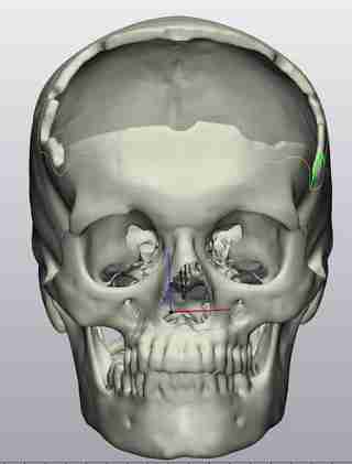 Куля влучила в голову і пройшла крізь мозок: у Львові зробили реконструкцію черепа захиснику (ФОТО)