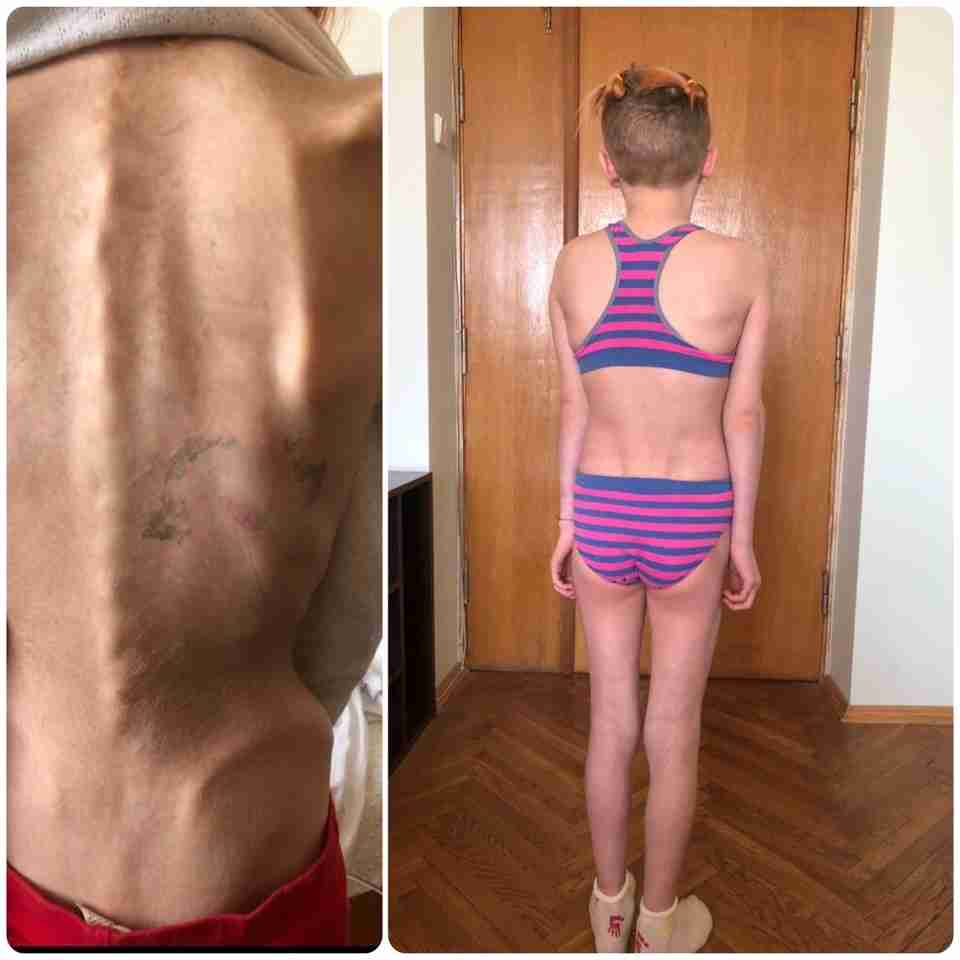 Лікарі врятували 12-річну дівчинку з Львівщини з анорексією (фото)