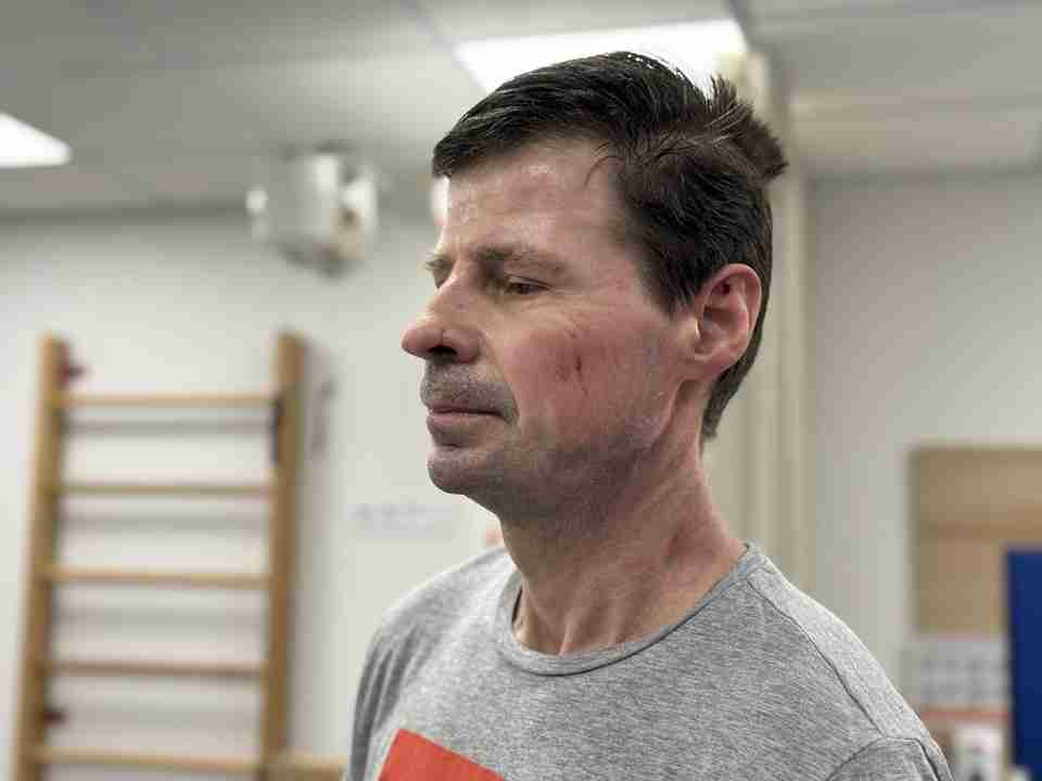 Львівські медики врятували чоловіка, який отримав 40% опіків тіла, коли смалив кабана до свят (ФОТО)