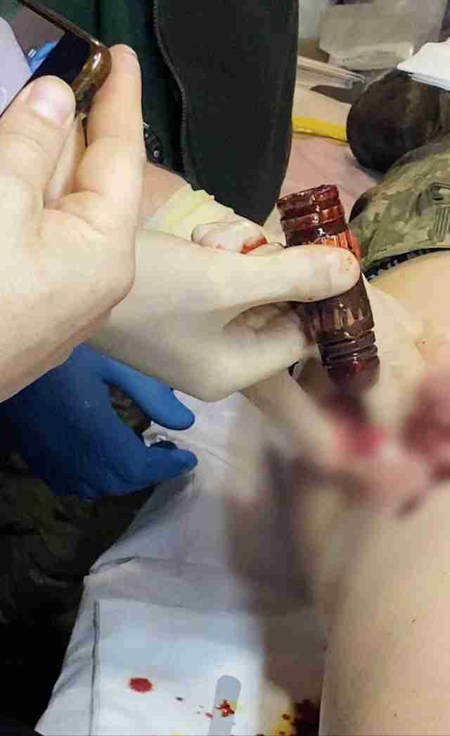 Медики врятували бійця ЗСУ, у тілі якого застряг бронебійний снаряд (фото)