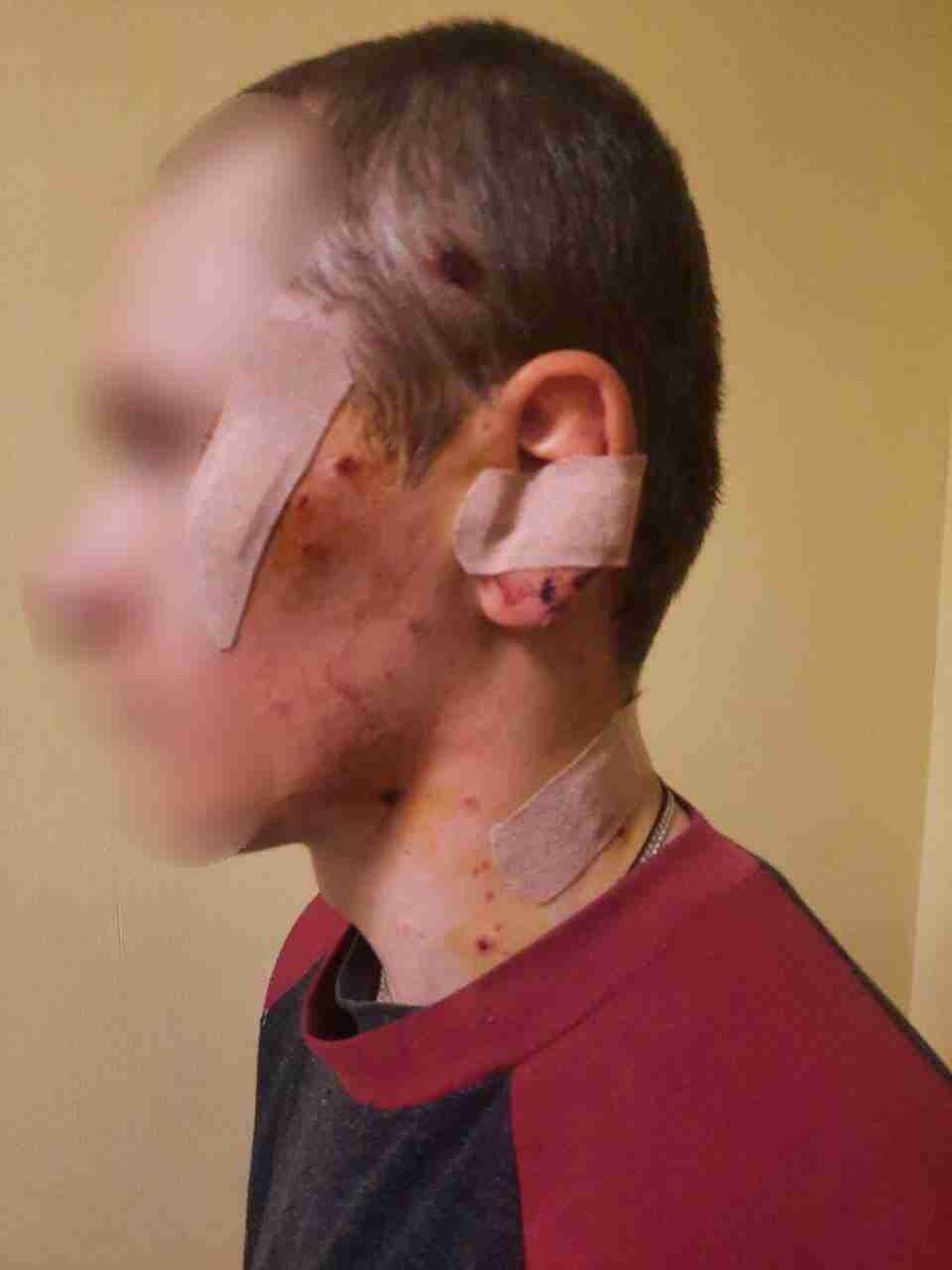 На Київщині 17-річний юнак підірвався на розтяжці (ФОТО)
