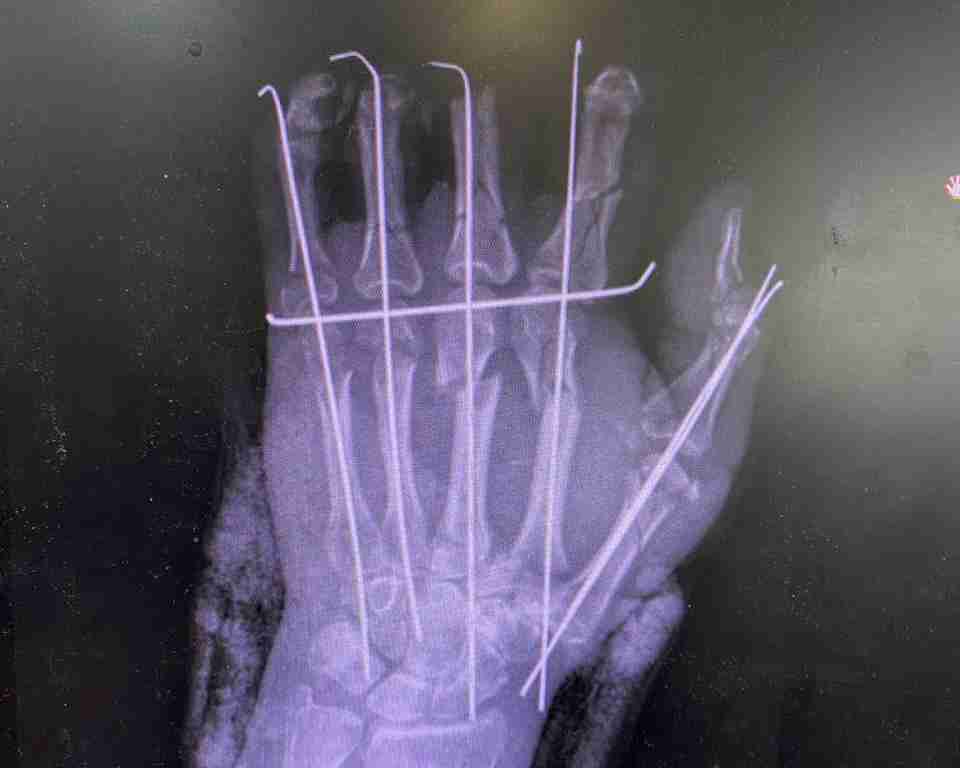 Понівечила руку в січкарні: львівські лікарі зберегли кінцівку жінці (ФОТО)