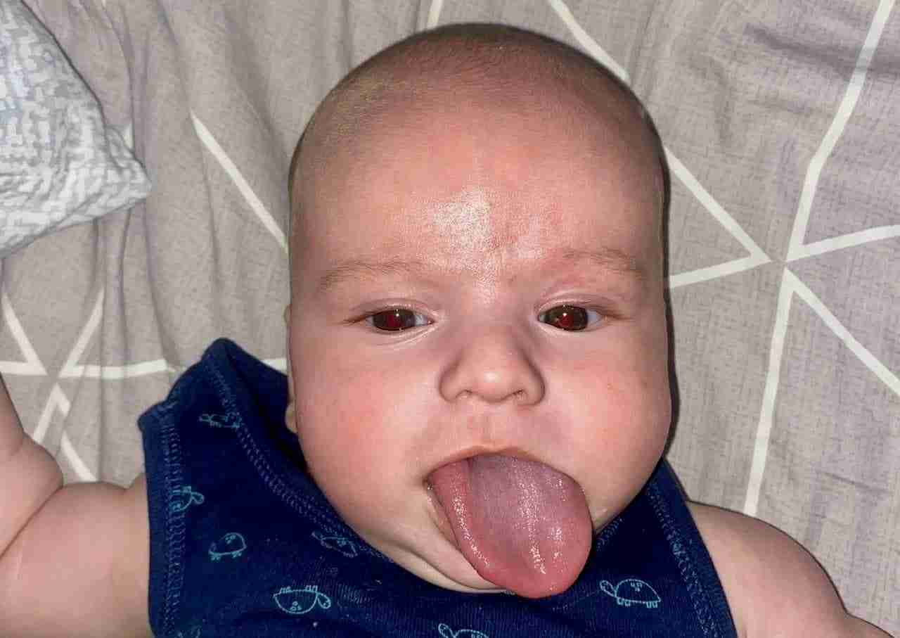 Рідкісний синдром: у Львові лікарі вкоротили немовляті язика (ФОТО)