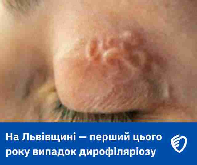 З ока львів’янина лікарі витягнули 11-сантиметрового гельмінта